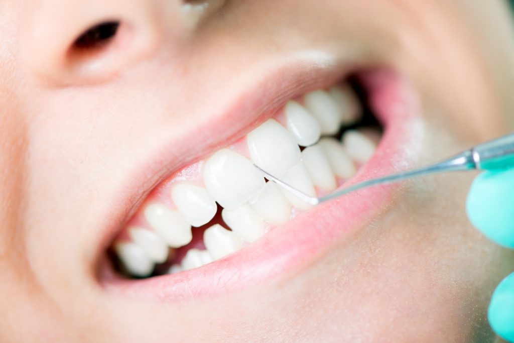 Teeth Cleaning and Polishing
